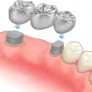 歯科ブリッジの構造