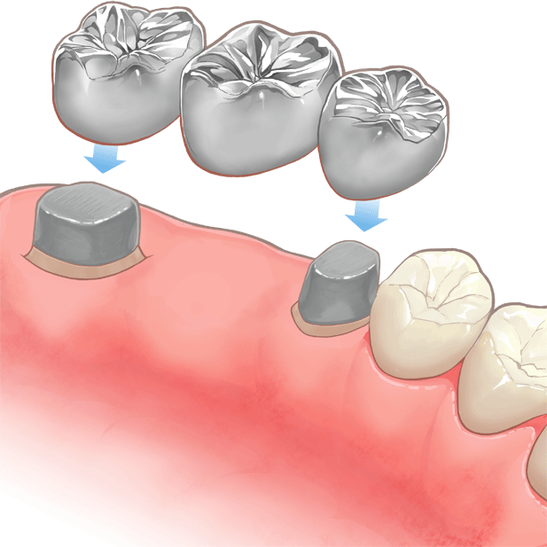歯科ブリッジの構造