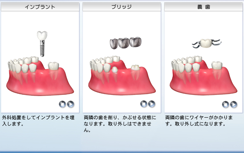 ブリッジの代替治療