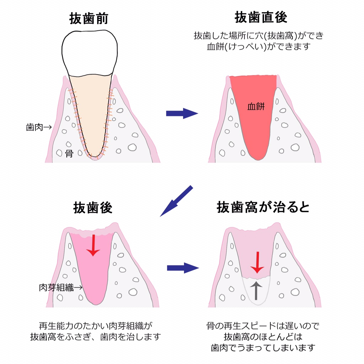 抜歯窩治癒