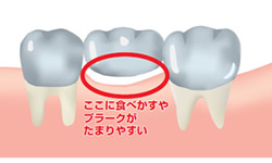 ポンティックしたのプラーク