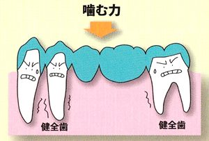 噛んだ時の歯にかかる力