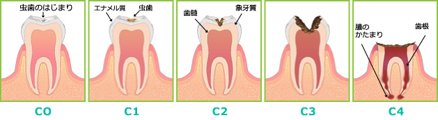 虫歯の進み方のイラスト