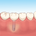 インプラントのイラスト