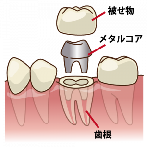 差し歯の構造　大臼歯