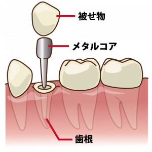 差し歯の構造　小臼歯