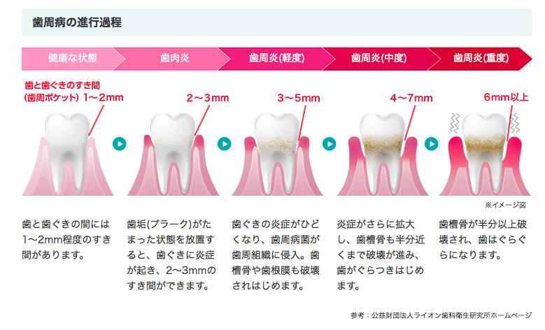歯周病進行イラスト