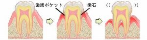 歯周病イラスト