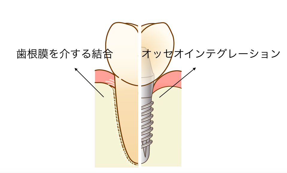 インプラントと天然歯の違い