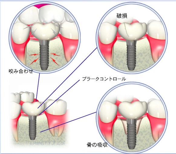 インプラントのメンテナンス