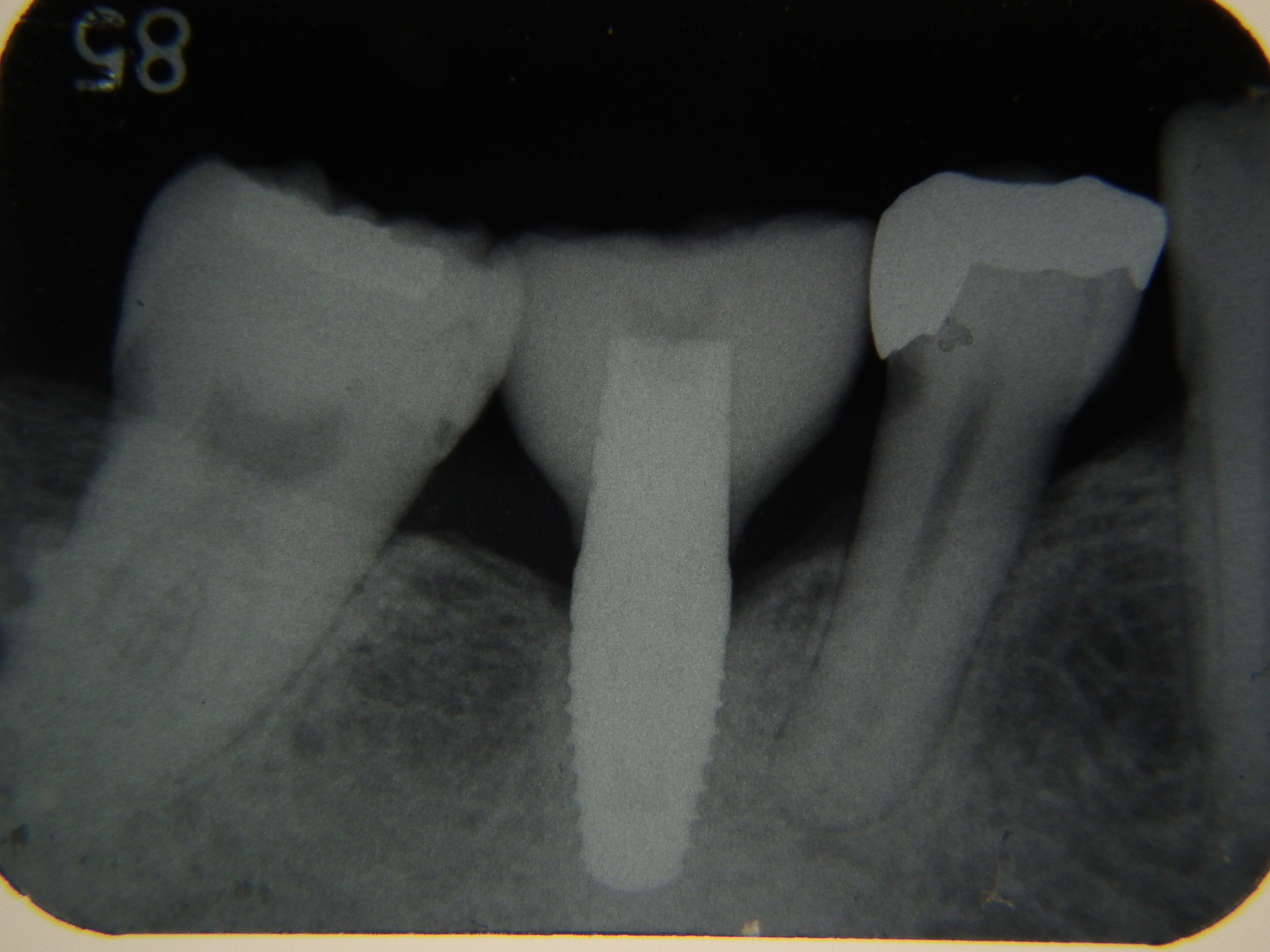 インプラントのレントゲン