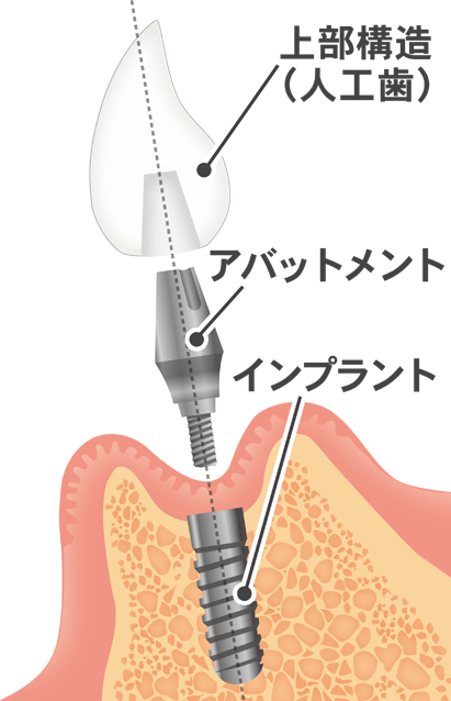 インプラント　構造