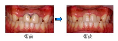 歯肉変化