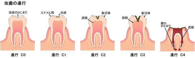 虫歯　進行