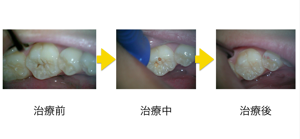 小児むし歯治療コンポジットレジン