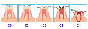むし歯進行