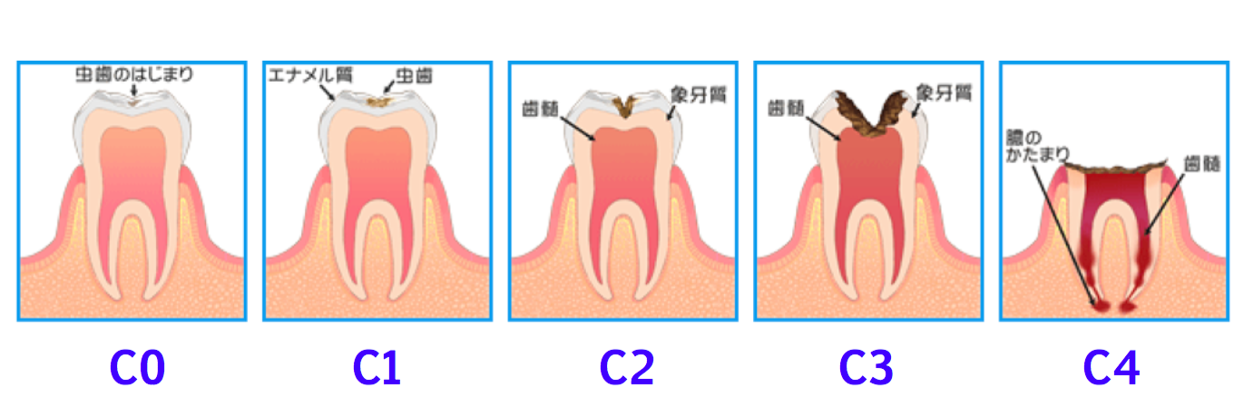 むし歯進行