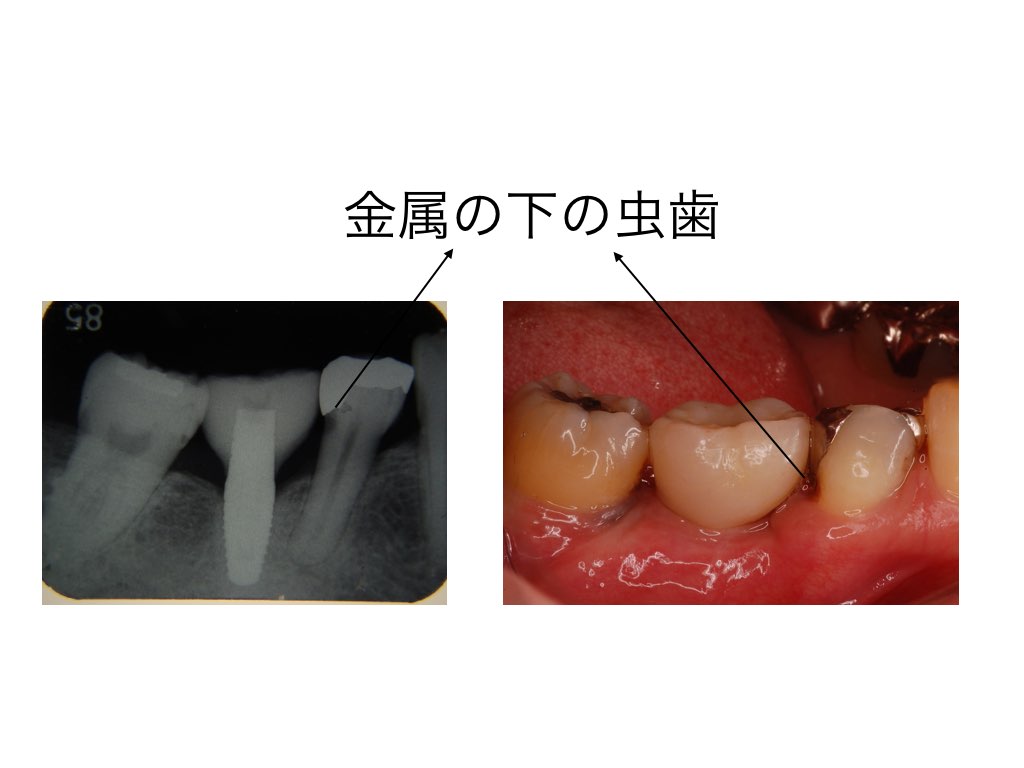 虫歯の見方