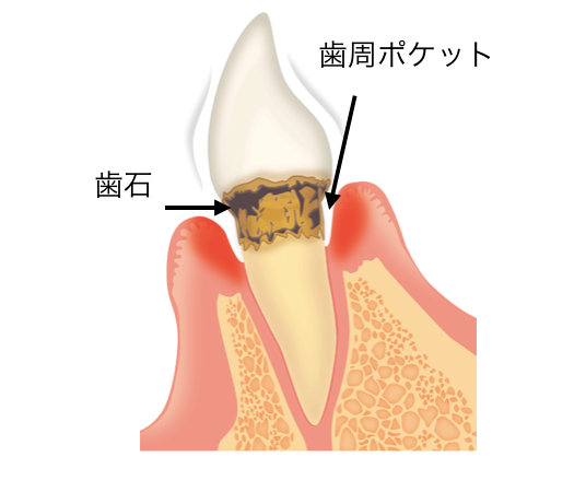 歯周病　ポケット