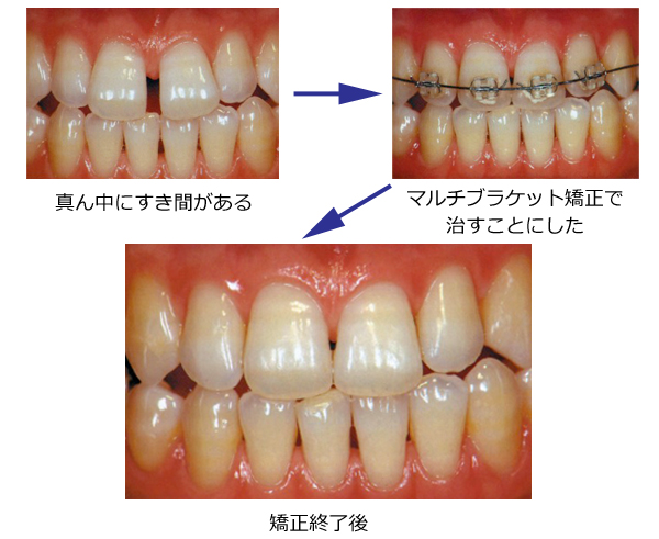 マルチブラケット矯正の説明