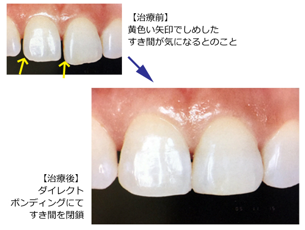 ダイレクトボンディングの画像