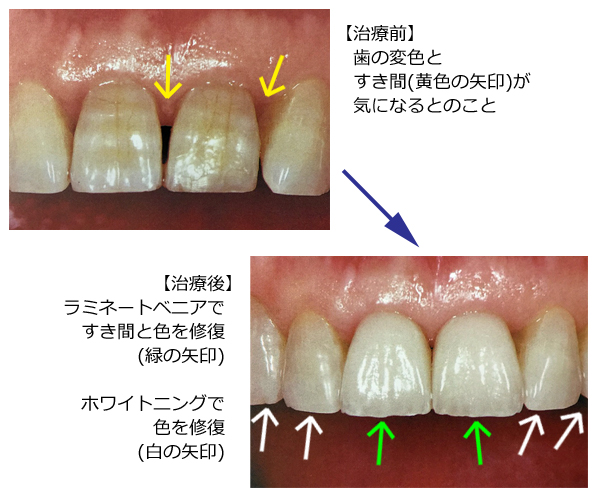 ラミネートベニアの画像