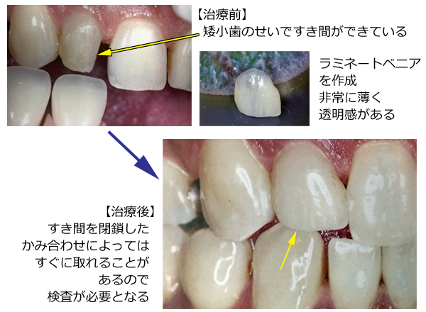 矮小歯をラミネートベニアで治療