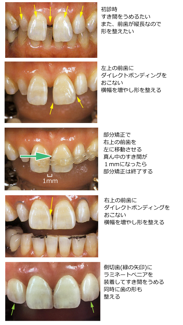 審美歯科治療の流れ