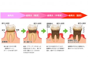 歯周病　進行