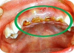 ボトルカリエス　子供の虫歯