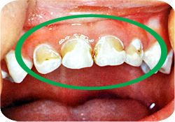 環状虫歯　子供