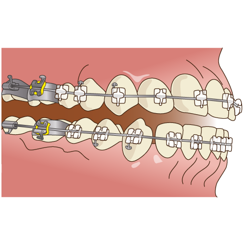マルチブラケット矯正