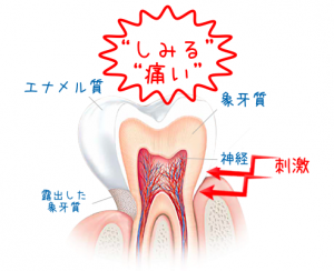 知覚過敏原因