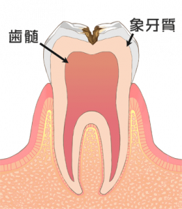 C2の虫歯