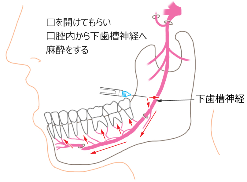 下顎孔伝達麻酔