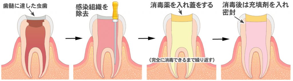 根管治療