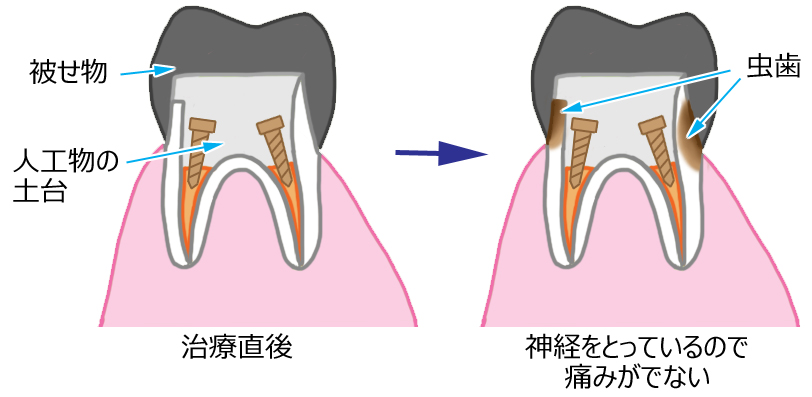 二次カリエス