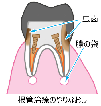 二次カリエス