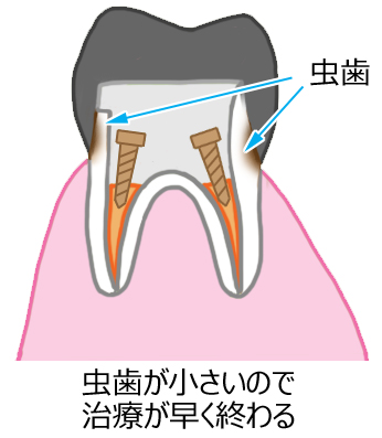 二次カリエス