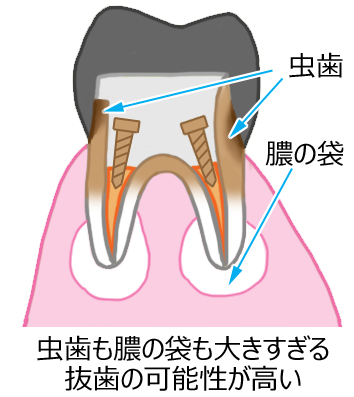 二次カリエス