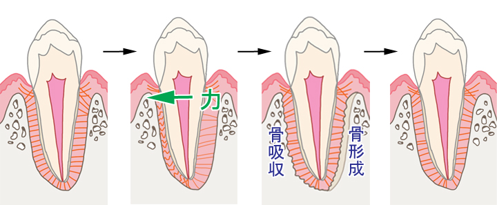 矯正での歯の動き方