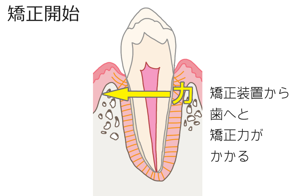 矯正力をかける