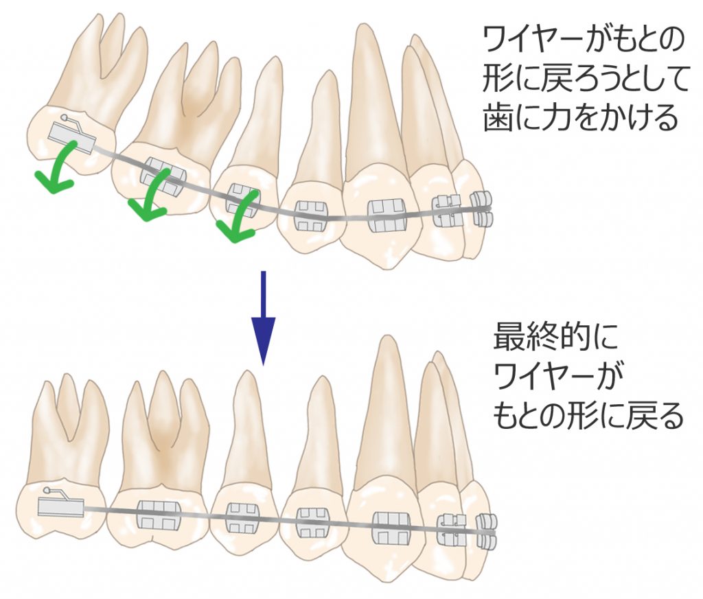 マルチブラケット矯正