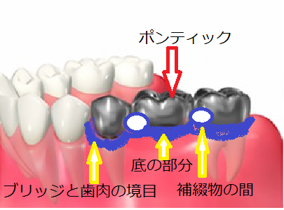 ブリッジ汚れ