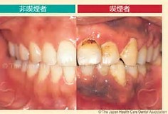 喫煙者の口腔内写真