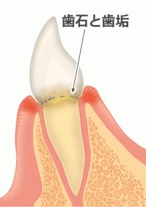 歯肉炎