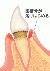 歯周病