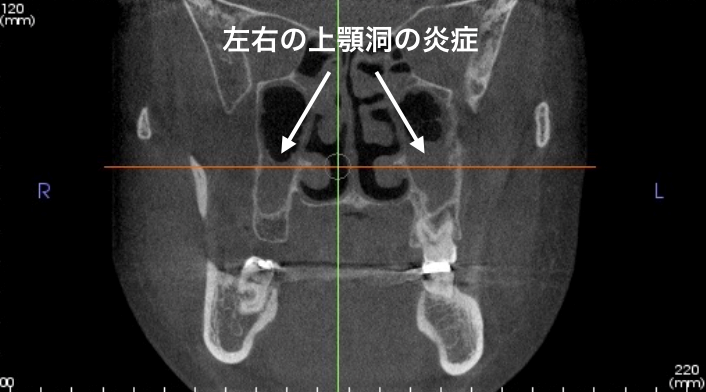 副鼻腔炎