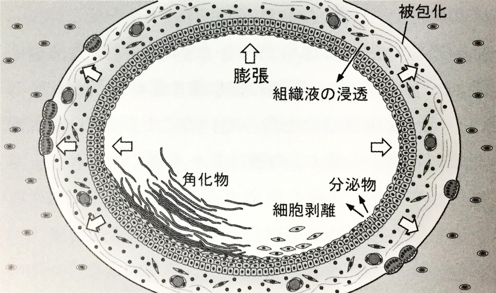 嚢胞