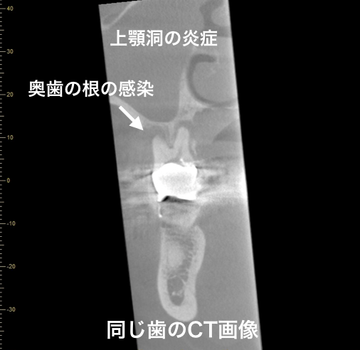 歯性上顎洞炎CT